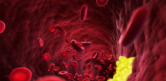 Evolocumab per modificare il processo aterosclerotico