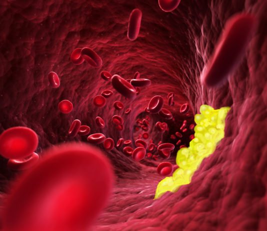 Evolocumab per modificare il processo aterosclerotico