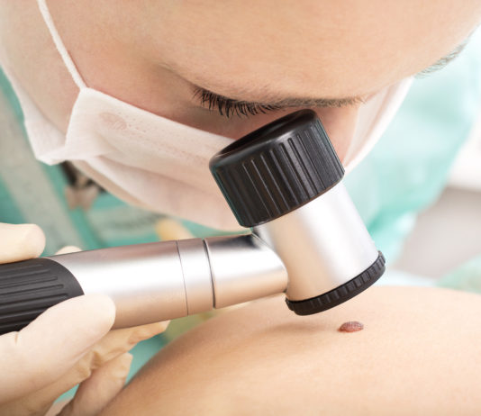 Cobimetinib/vemurafenib per il melanoma approvato in Italia