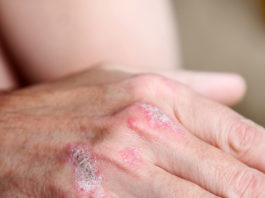 Ixekizumab per la psoriasi