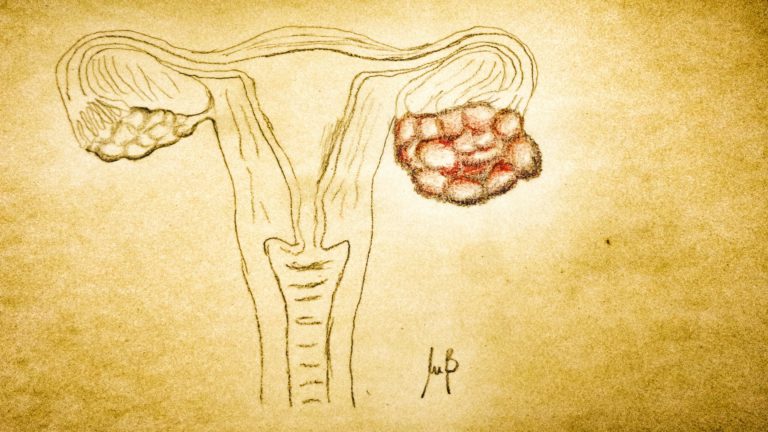 Lurbinectedina per il carcinoma ovarico platino-resistente