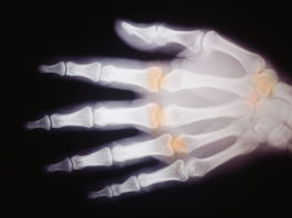 Certolizumab pegol vs adalimumab per l’artrite reumatoide