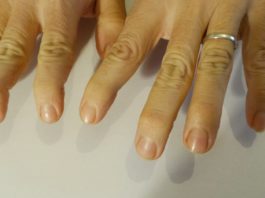 Secukinumab si conferma efficace per tre anni sull’AP