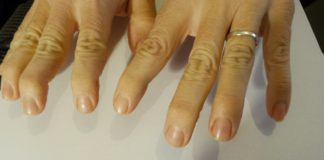 Secukinumab si conferma efficace per tre anni sull’AP