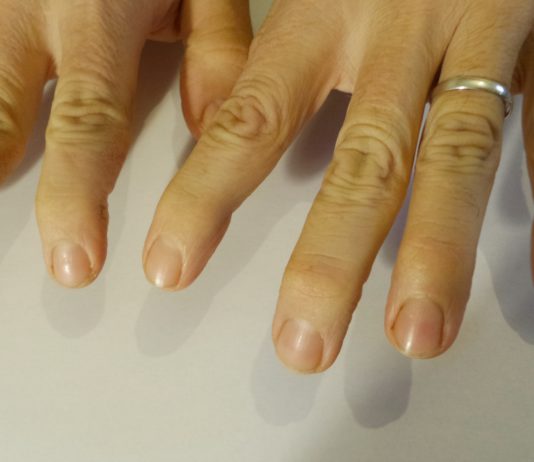 Secukinumab si conferma efficace per tre anni sull’AP