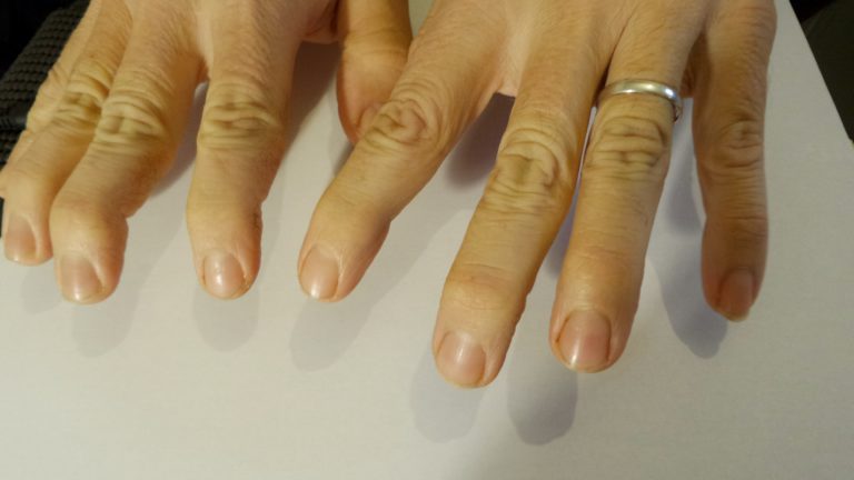 Secukinumab si conferma efficace per tre anni sull’AP