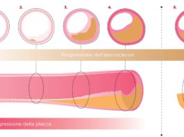 Evolocumab per ridurre la placca aterosclerotica