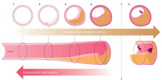 Evolocumab per ridurre la placca aterosclerotica