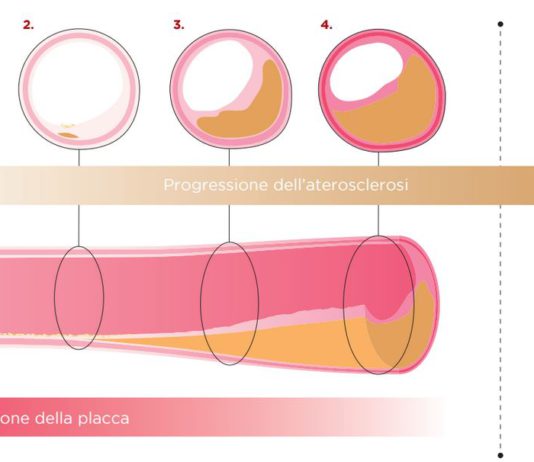 Evolocumab per ridurre la placca aterosclerotica