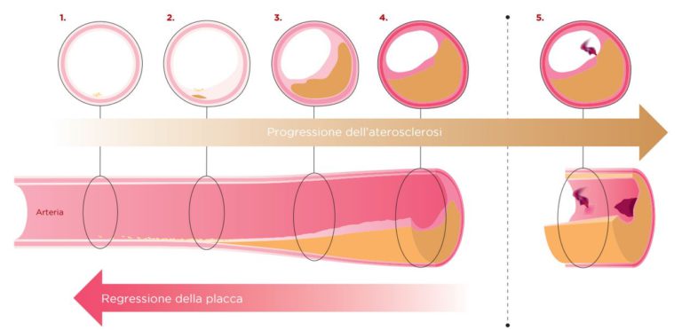 Evolocumab per ridurre la placca aterosclerotica
