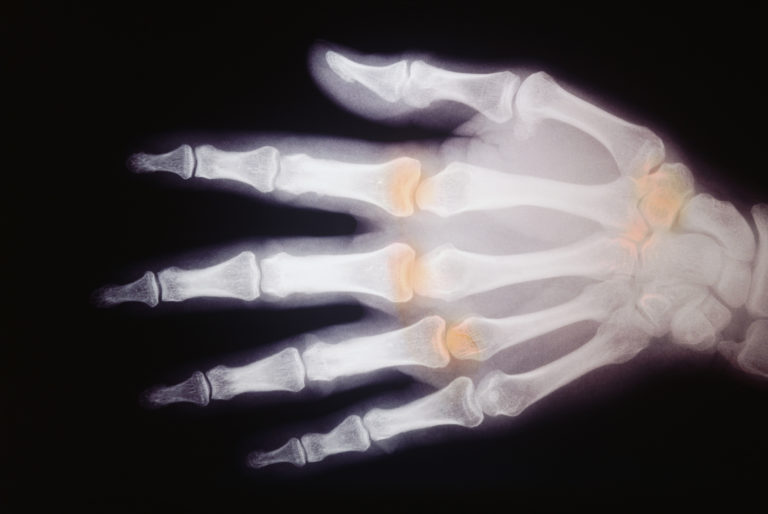 Tofacitinib citrato per l’artrite reumatoide attiva da moderata a grave