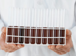 Leucemia linfatica cronica