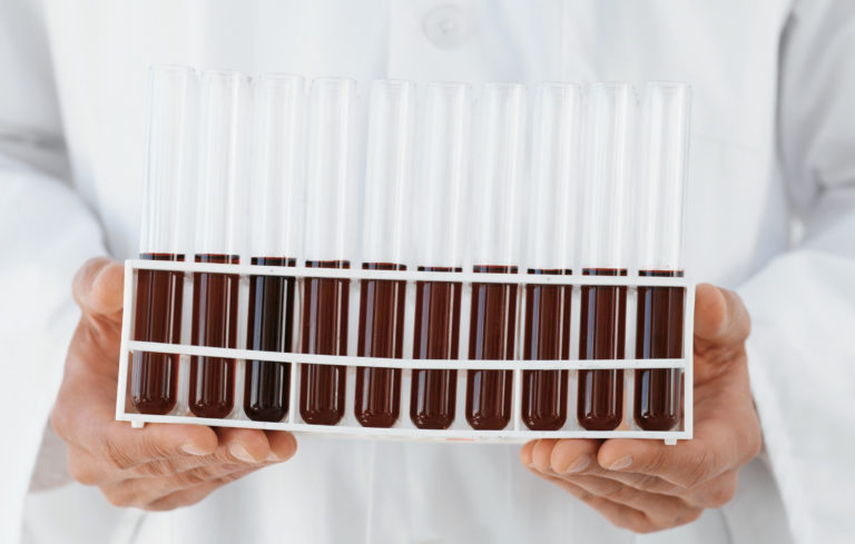 Leucemia linfatica cronica