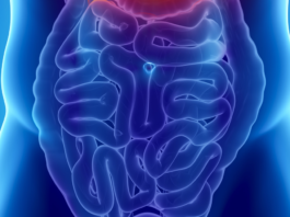 Biosimilare infliximab per le malattie infiammatorie croniche intestinali
