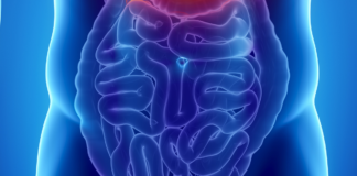 Biosimilare infliximab per le malattie infiammatorie croniche intestinali
