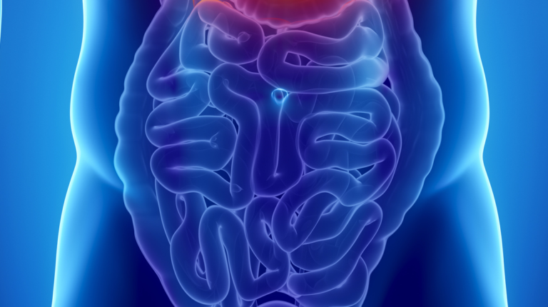 Biosimilare infliximab per le malattie infiammatorie croniche intestinali