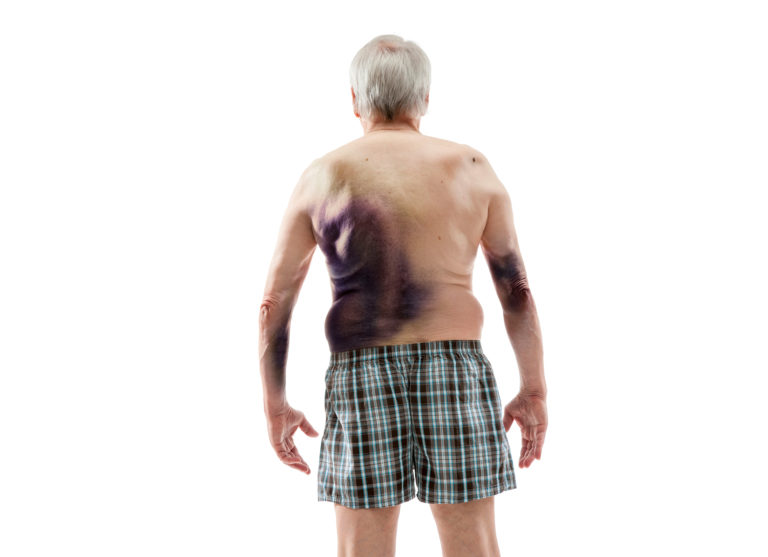 Emofilia: nuova stima del tasso globale annuo di sanguinamenti