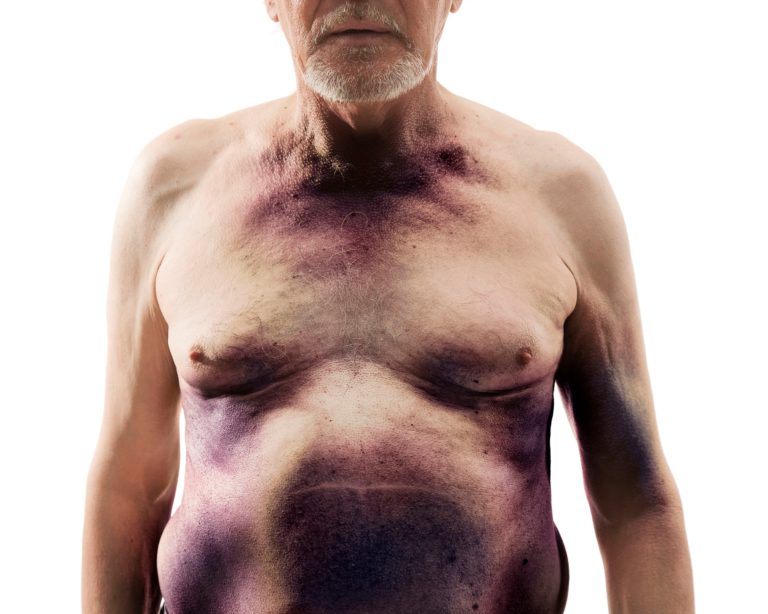 L’emofilia A acquisita