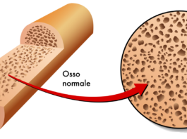 Neridronato per l’edema osseo