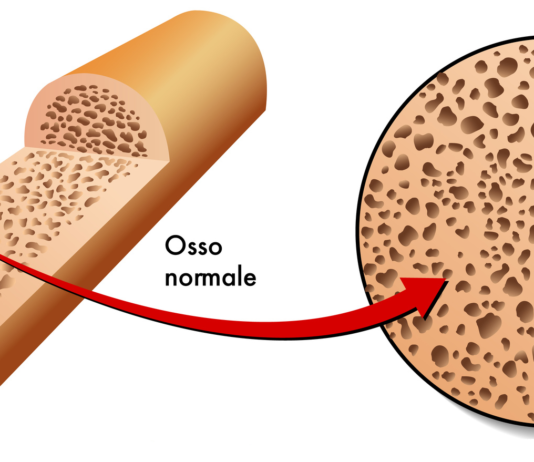 Neridronato per l’edema osseo