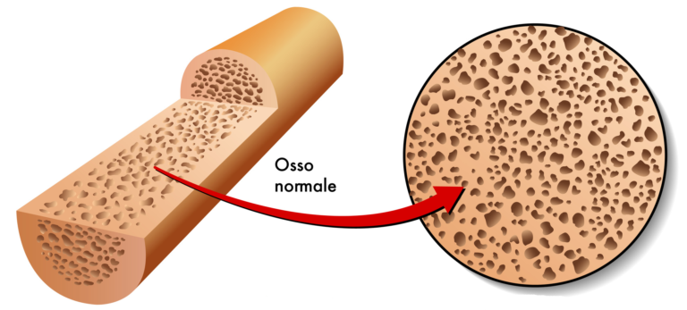 Neridronato per l’edema osseo