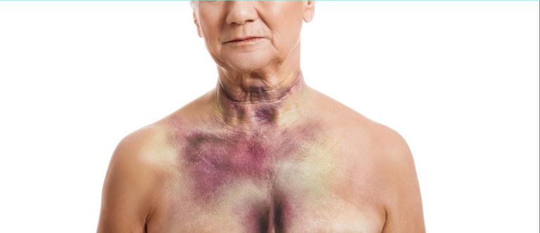 Susoctocog alfa per l’emofilia A acquisita disponibile in Italia