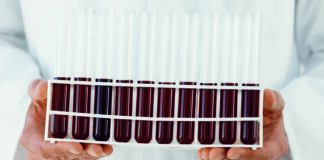 Bay 81-8973 (octocog alfa) per l’emofilia A rimborsabile in Italia Bay 81-8973 (octocog alfa) per l'emofilia A, usato due o tre volte a settimana, ha dimostrato di mantenere l’emostasi e di proteggere dai sanguinamenti