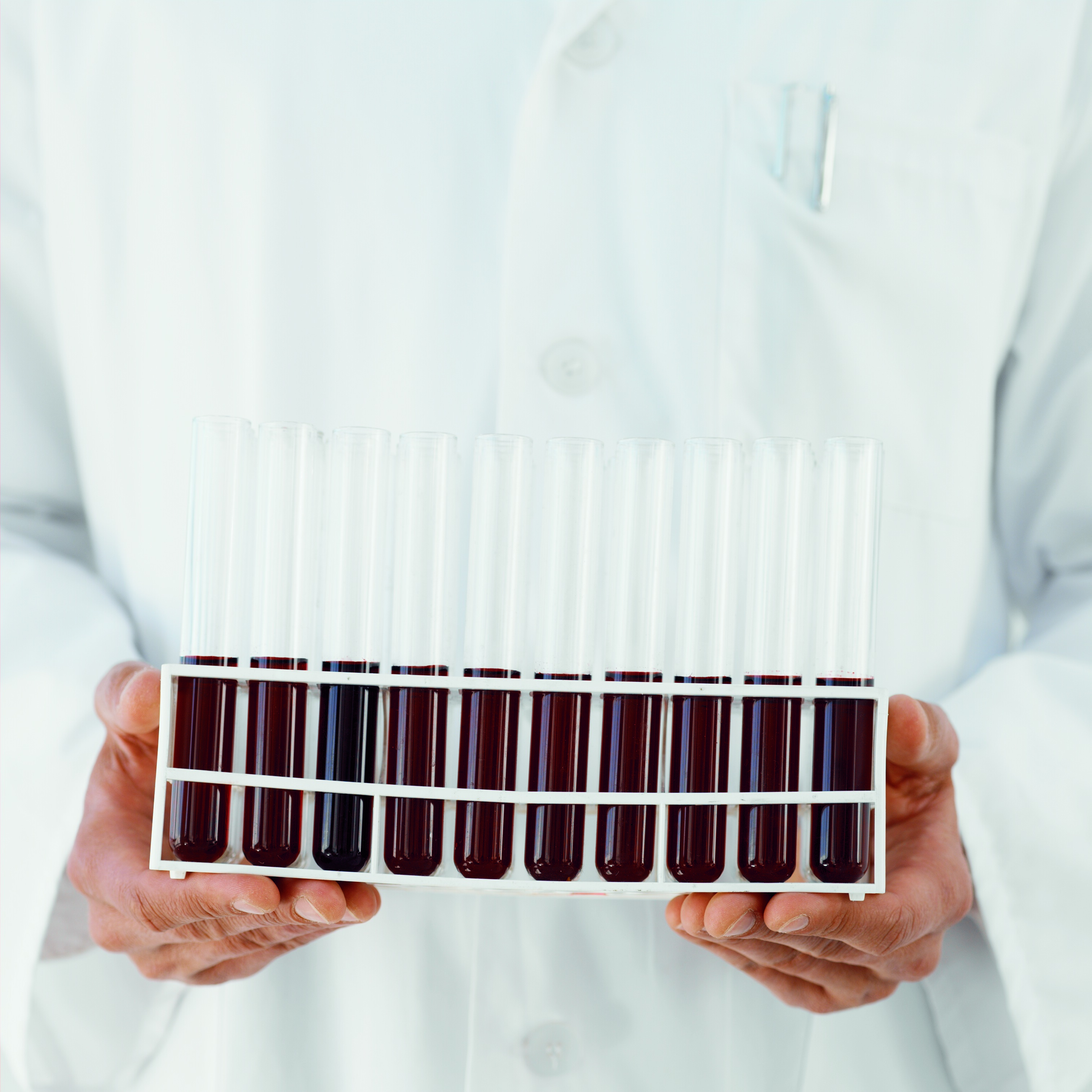 Bay 81-8973 (octocog alfa) per l'emofilia A, usato due o tre volte a settimana, ha dimostrato di mantenere l’emostasi e di proteggere dai sanguinamenti