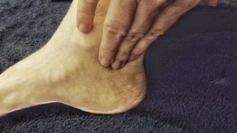 Diagnosi e terapie dell’arteriopatia obliterante periferica per prevenire le amputazioni