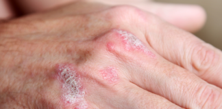Secukinumab è potenzialmente in grado di modificare la storia naturale della psoriasi