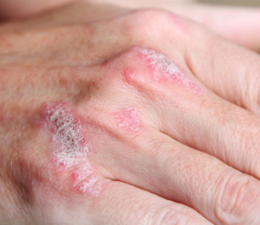 Secukinumab è potenzialmente in grado di modificare la storia naturale della psoriasi