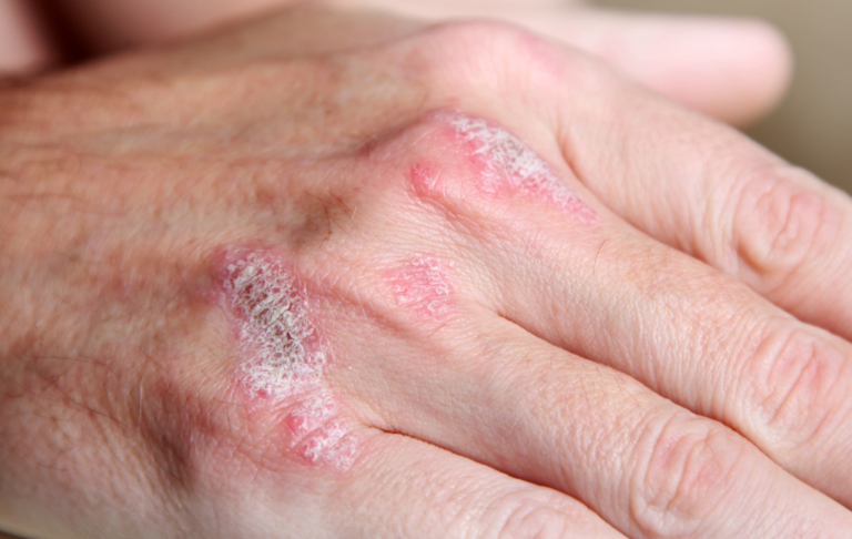 Secukinumab è potenzialmente in grado di modificare la storia naturale della psoriasi