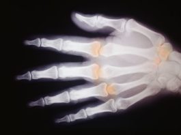 Baricitinib per l’artrite reumatoide La CE ha approvato baricitinib per l'artrite reumatoide da moderata a grave in pazienti adulti che non ottengono miglioramenti significativi con i DMARD