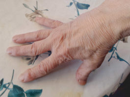 Artrite reumatoide L’artrite reumatoide (AR) è una malattia sistemica cronica che coinvolge diversi organi. È caratterizzata dall'infiammazione delle sinovie