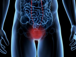 Paclitaxel e acido ialuronico per il tumore della vescica in situ Il bio-coniugato Oncofid-P-B, composto da paclitaxel e acido ialuronico per il tumore della vescica in situ vine valutato in uno studio di fase I