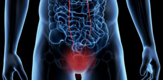 Paclitaxel e acido ialuronico per il tumore della vescica in situ Il bio-coniugato Oncofid-P-B, composto da paclitaxel e acido ialuronico per il tumore della vescica in situ vine valutato in uno studio di fase I
