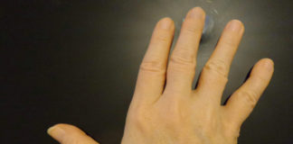 Sarilumab per l’artrite reumatoide approvato dall’EMA