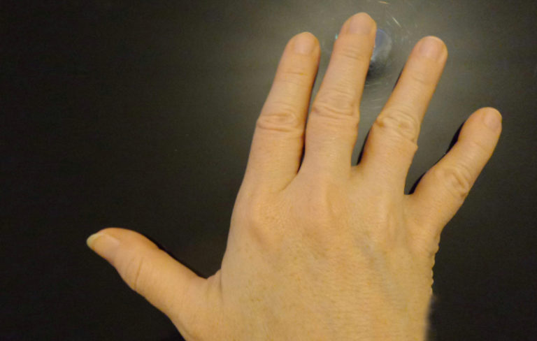 Sarilumab per l’artrite reumatoide approvato dall’EMA