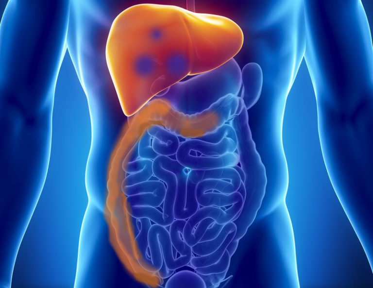 Microsfere con ittrio-90 per metastasi al fegato da tumore primario al lato destro del colon