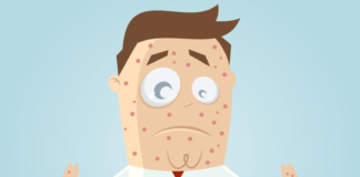 Dupilumab per la dermatite atopica
