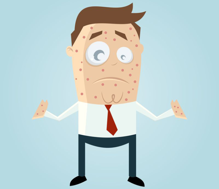 Dupilumab per la dermatite atopica