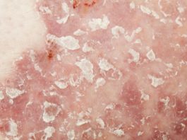 Brodalumab per la psoriasi a placche