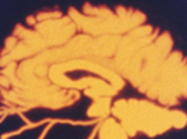 Ictus cerebrale e impatto della fibrillazione atriale