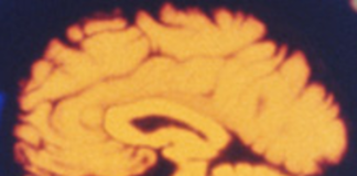 Ictus cerebrale e impatto della fibrillazione atriale