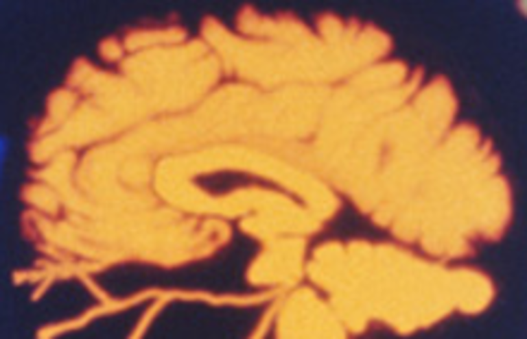 Ictus cerebrale e impatto della fibrillazione atriale