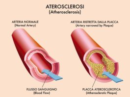 Evolocumab in pazienti con storia di ictus