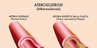 Evolocumab in pazienti con storia di ictus