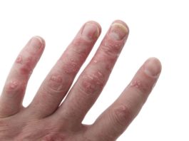 Studio di estensione su secukinumab per la psoriasi