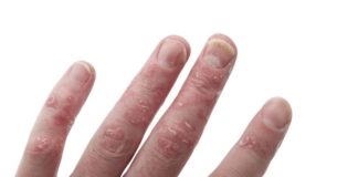 Studio di estensione su secukinumab per la psoriasi