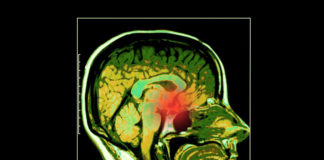 Lanreotide autogel HD e HF per l’acromegalia